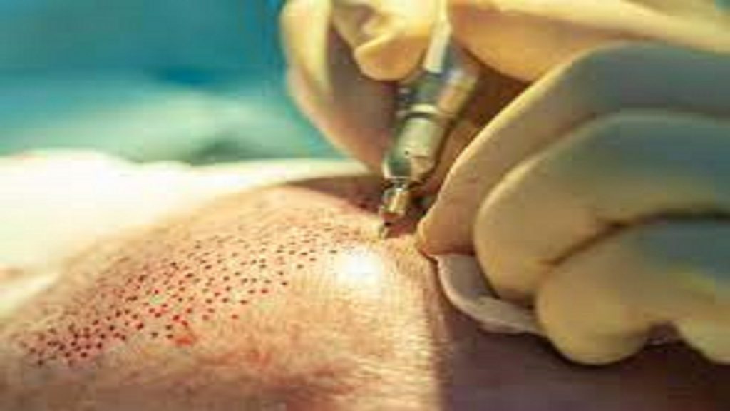Things to know before undergoing a hair transplant.